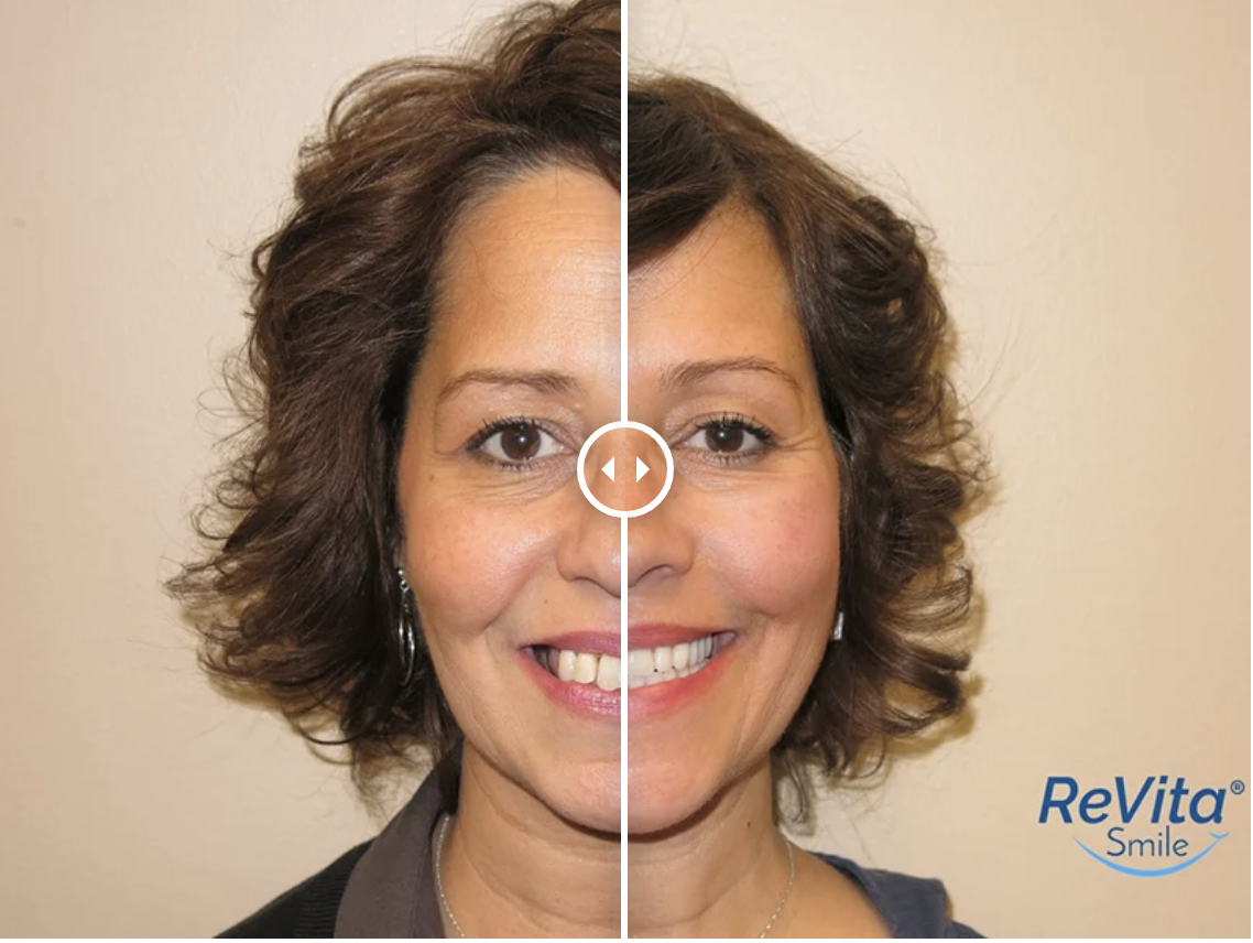 Full Arch Dental Implants Smile Gallery | North Shore Smile Surgery